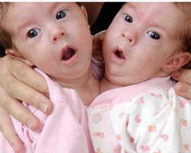 异于常人:连体人 Inside Extraordinary Humans: Science of Conjoined Twins的海报