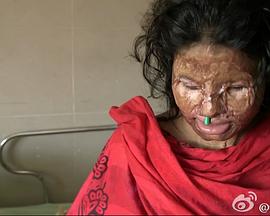 社会生活纪录片《无脸女孩 The Girl Who Lost Her Face》下载-零三纪录片资源网